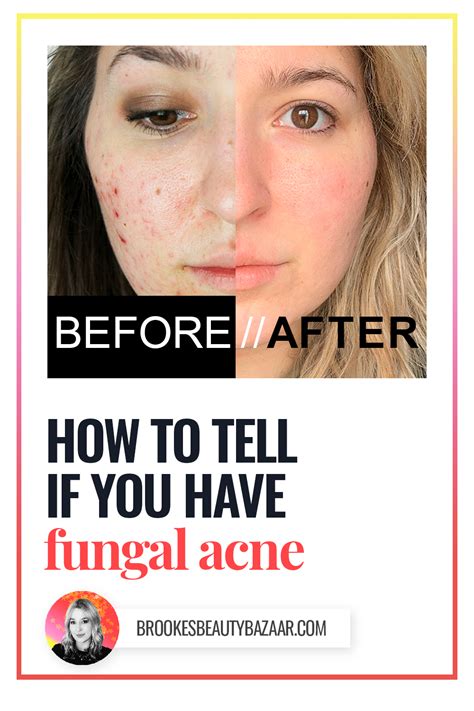 How To Tell If You Have Fungal Acne Brookes Beauty Bazaar