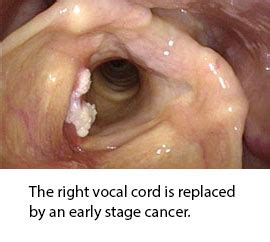 If the hoarseness doesn't go away within two weeks, see a doctor. Laryngeal Cancer | The MetroHealth System