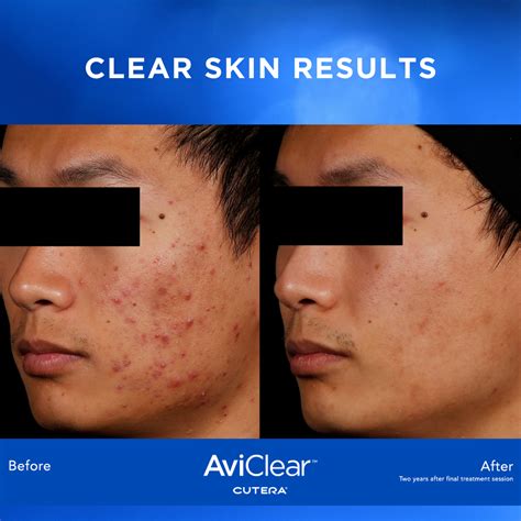 Aviclear Laser Acne Treatment By A Greater Houston Tx Dermatologist Dermsurgery Associates