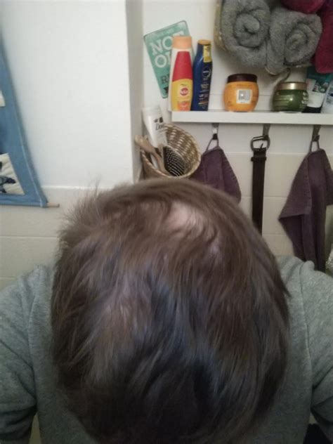 Balding At 15 Advice On What To Do Im Really Getting Mocked And