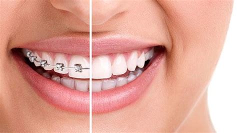 Five Options To Get Affordable Braces For Adults Affordable Braces Dental Braces Braces