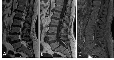 Cureus Acute Presentation Of Lumbar Spinal Schwannoma Due To Torsion