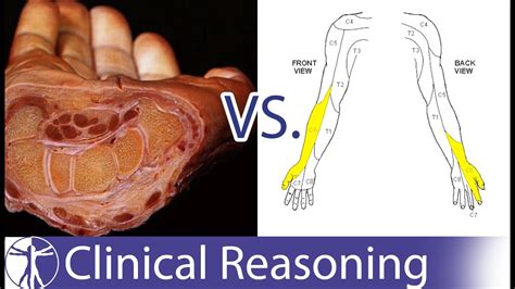 Carpal Tunnel Syndrome Mimicking C6 C7 Radiculopathy Youtube