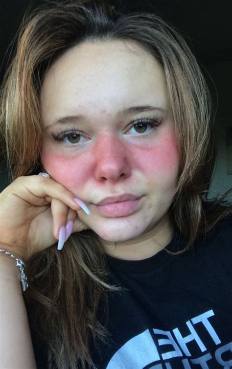 Teenager With Lupus Rash On Her Face Shows Off Her 90 Minute Beauty