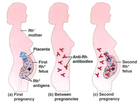 Carry the rh d antigen are identified as rh d negative. Utility of Anti-D Immunoglobulin(Rho Gam) During First ...