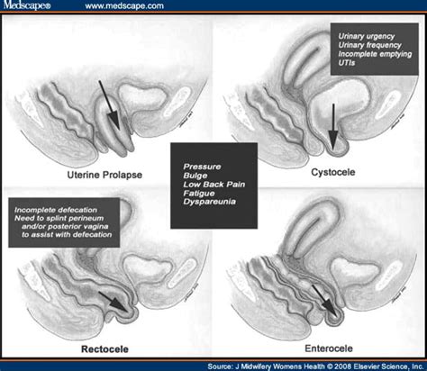 Biomechanics Applied To Pelvic Organ Prolapse Prevention