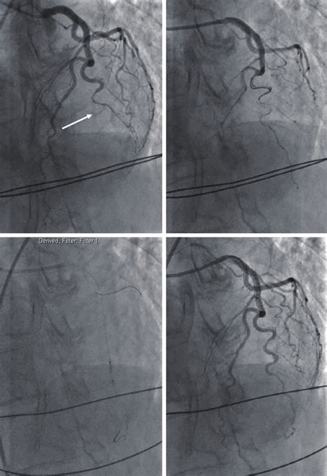 Coronary Angiogram Showing Spontaneous Coronary Artery Dissection