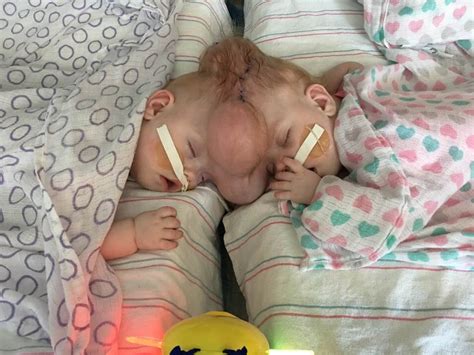 6 Years Later Rare Conjoined Twins Who Survived Separation Surgery