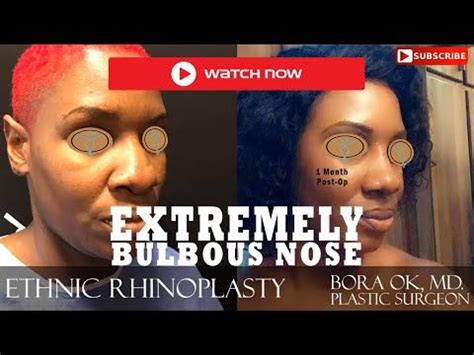 Courtesy of the asaps smart beauty guide. Pin on nose job