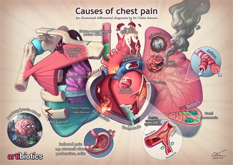 Heart, lungs, esophagus, large blood vessels, as well as muscles, bones (ribs) and cartilage (costal). Causes of chest pain — artibiotics