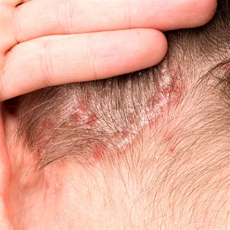 Dermatitis Seborreica En El Cuero Cabelludo Mayo Clinic Hot Sex Picture