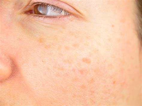 Fighting Melasma How To Reduce Hormonal Dark Spots On Your Skin Easy