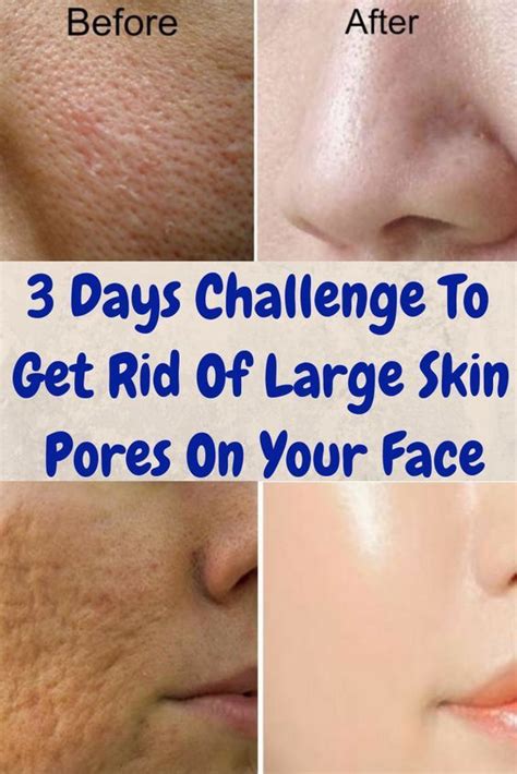 3 Days Challenge To Get Rid Of Large Skin Pores On Your Face Open