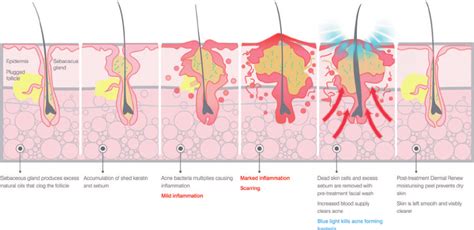 Pathology Of Acne Vulgaris Download Scientific Diagram