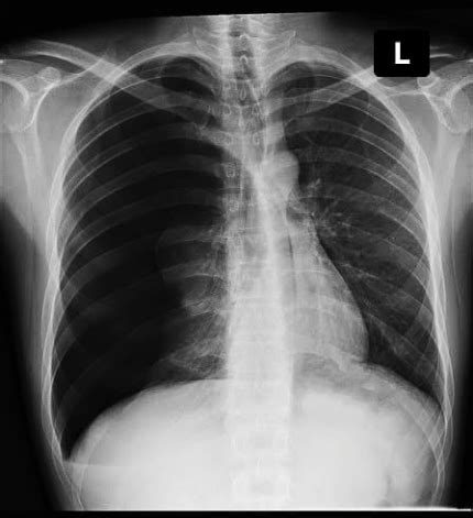 A Massive Primary Spontaneous Pneumothorax During The Recovery Phase Of