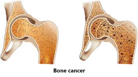Bone Cancer Bone Neoplasm Causes Symptoms And Treatment