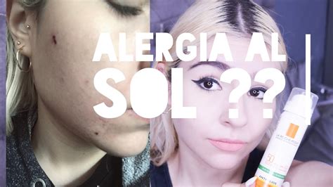 Alergia Al Sol Como Sobrevivir A Ella Youtube