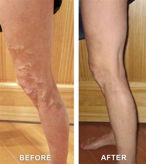 Before And After Vein Treatment Gallery Vincent Vein Center