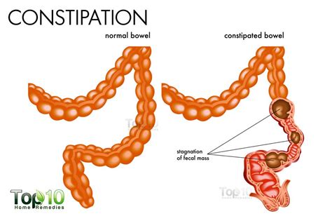 Constipation Constipation Is Infrequent Bowel By Orcasho Medium