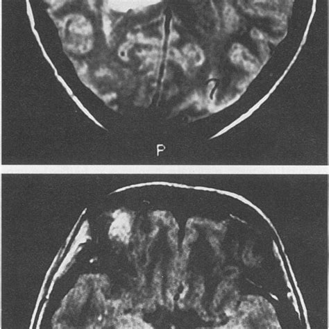 Frontal Lobe Tumor Patient 2 Presented With Personality Change From