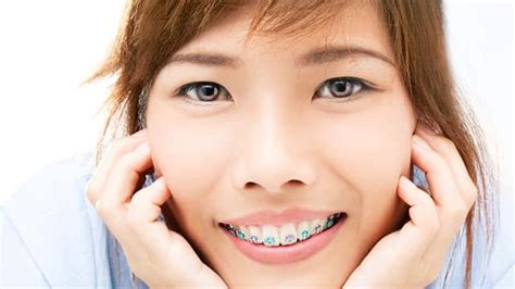The Things You Should Know About Adult Braces Omn 305