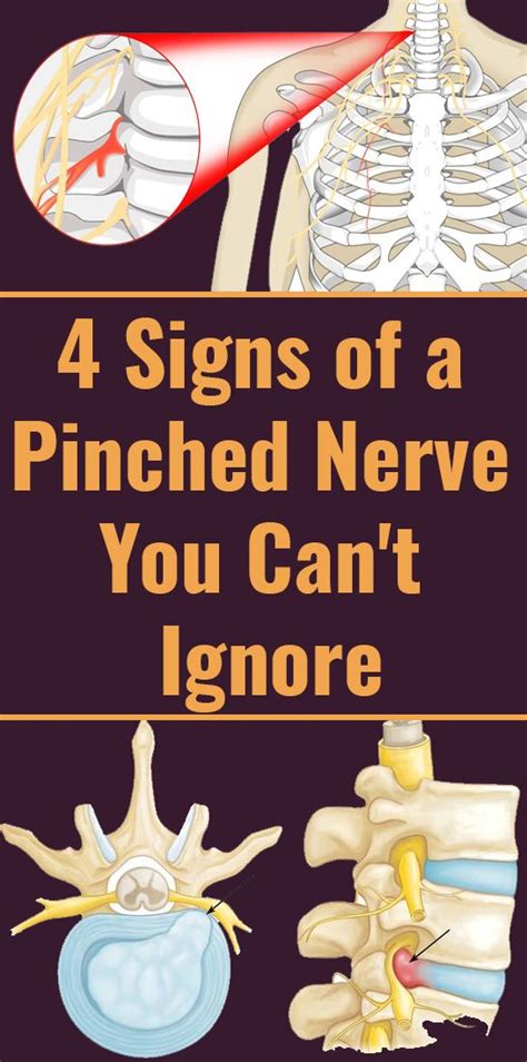 Pinched Nerve Symptoms Locations And Treatments Pinched Nerve Nerve