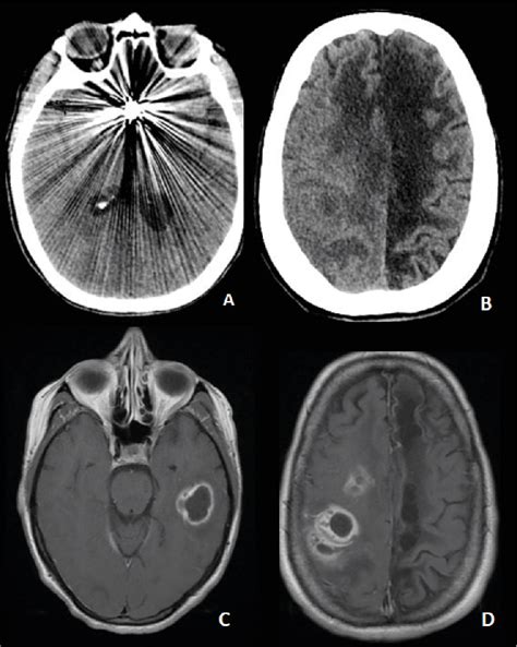 Figure 1 From Bihemispheric Cerebral Abscesses From Infected Anterior