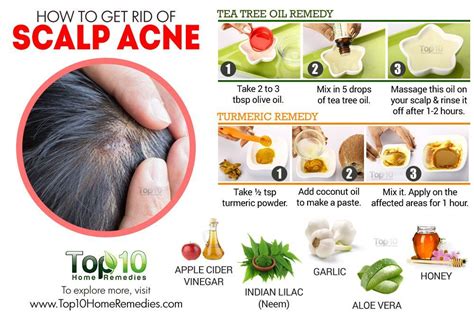 Image Result For Bumps On Scalp Pictures Scalp Acne Pimples On Scalp