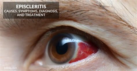 Episcleritis Causes Symptoms Diagnosis Treatment