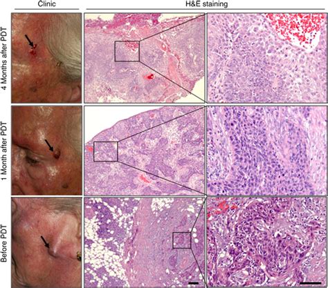 Clinical And Histological Evolution Of A Squamous Cell Carcinoma Scc