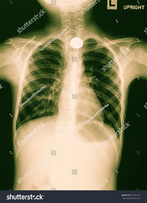 X Ray Film Child Who Swallowed Stock Photo 257797252 Shutterstock