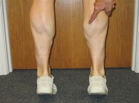 Right Gastrocnemius Appearance Of Fascial Herniation Download