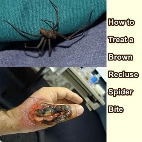 Collection Pictures Identifying A Spider Bite By Pictures Sharp
