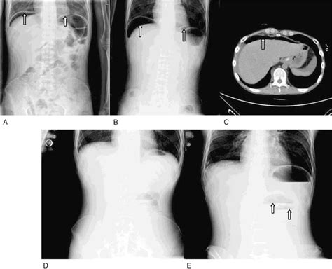 Multiple Small Bowel Perforations Due To Cytomegalovirus Rel Medicine