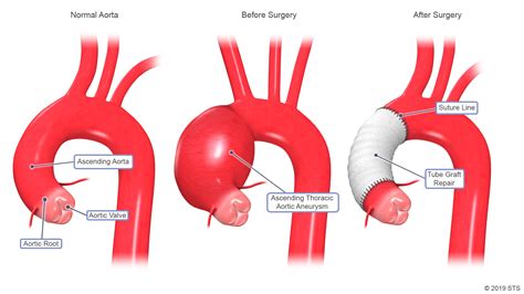 Aneurisma de aorta torácica quando operar Artículos IntraMed