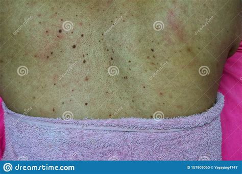 Close Up Of The Skin On The Back Of Women With Skin Diseases Allergies
