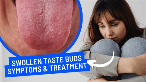 What Are Swollen Taste Buds And Causes Symptoms And Treatment Youtube