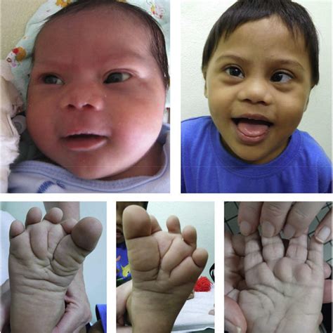 Pdf A Child With Complementary Mosaic Trisomy 8 And Mosaic Trisomy 21