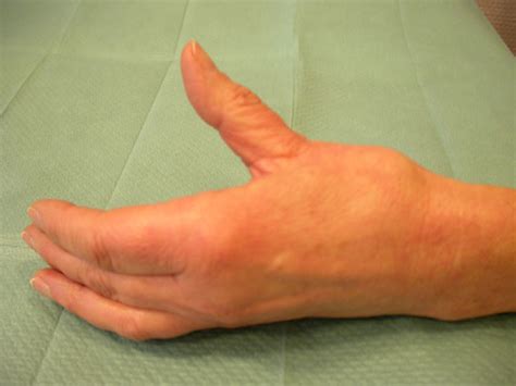 Hand Arthrose Roland Klinik