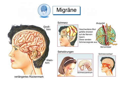 Starke Kopfschmerzen Hinter Den Augen Augen De