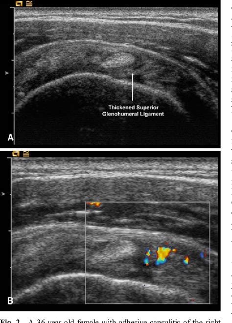 Adhesive Capsulitis Sonographic Changes In The Rotator Cuff Interval