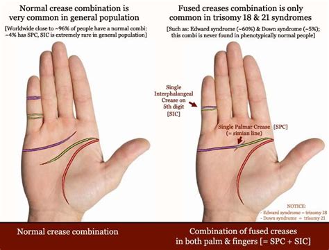 Aberrant Palmar Transverse Creases In Down Syndrome Simian Crease