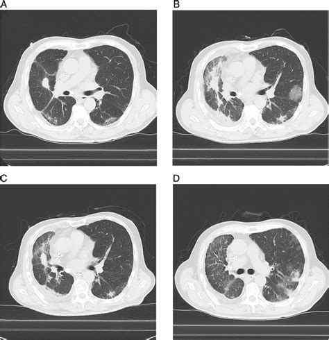 Chest Computed Tomography Ct Scans Of The Left Upper Lobe Of The Lung