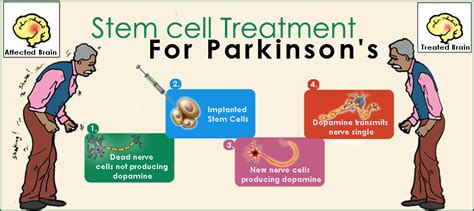 Our Parkinsons Place International Stem Cell Corporation Announces