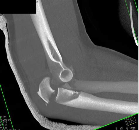 3d Map Of Fracturedislocation Elbow With Multiple Fractures Trauma