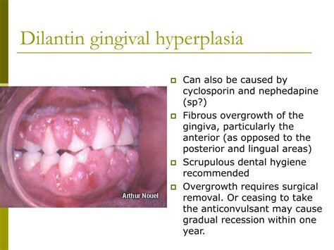 Dilantin Gingival Hyperplasia