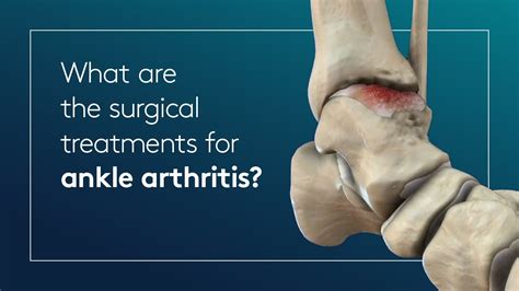 Foot And Ankle Arthritis Causes Symptoms And Treatment Otosection