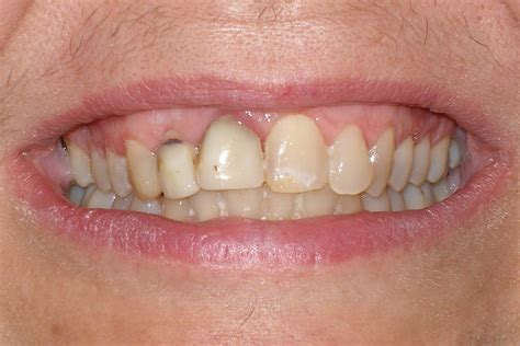 Veneers Smile Gallery Raber Dental Kidron Dentist