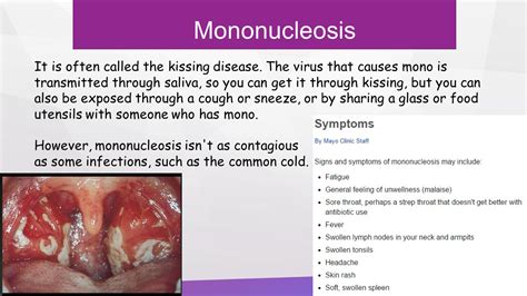 Mono is called the kissing disease because it spreads via saliva. Childhood Diseases - On a Mission to Educate: Infectious ...
