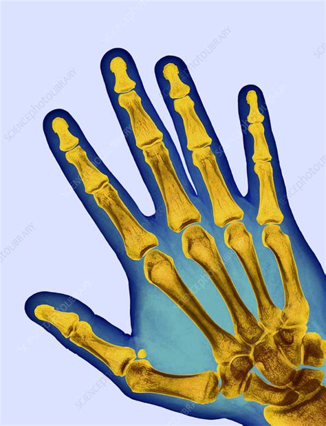 Healthy Adult Hand X Ray Stock Image P1160724 Science Photo Library